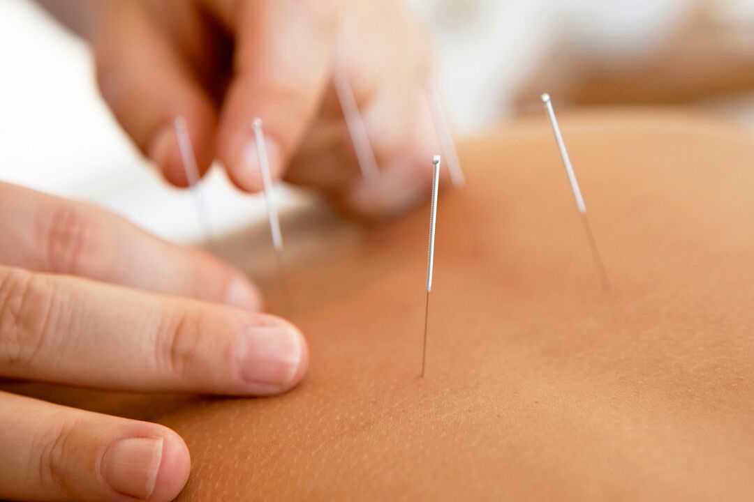 akupunktura ke zvýšení potence